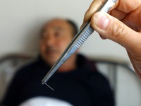 Из китайца извлекли иглу, засевшую в нем 31 год назад