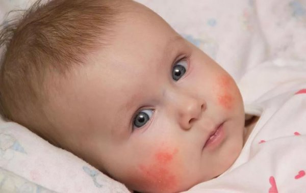 Детские болезни становятся хроническими. Аллергия у детей