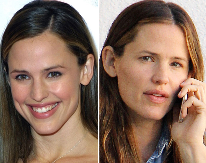 Бес пластической хирургии испортил улыбки звезд