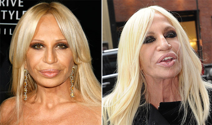 Донателла Версаче. Звездные неудачи, или Ошибки пластических хирургов