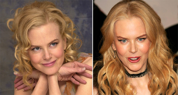 Николь Кидман. Звездные неудачи, или Ошибки пластических хирургов