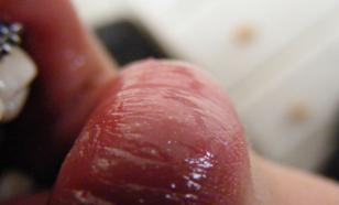 Почему трескаются губы: пять неочевидных причин