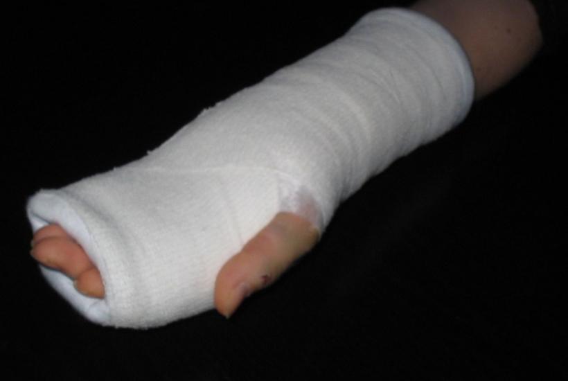 Рука в гипсе
