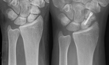 Исследование показало ужасающую правду: раненные и убитые в ледниковый период