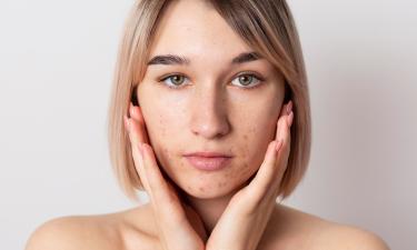 Конец бесконечным кремам и таблеткам: новая вакцина обещает стереть акне навсегда — но есть одно но