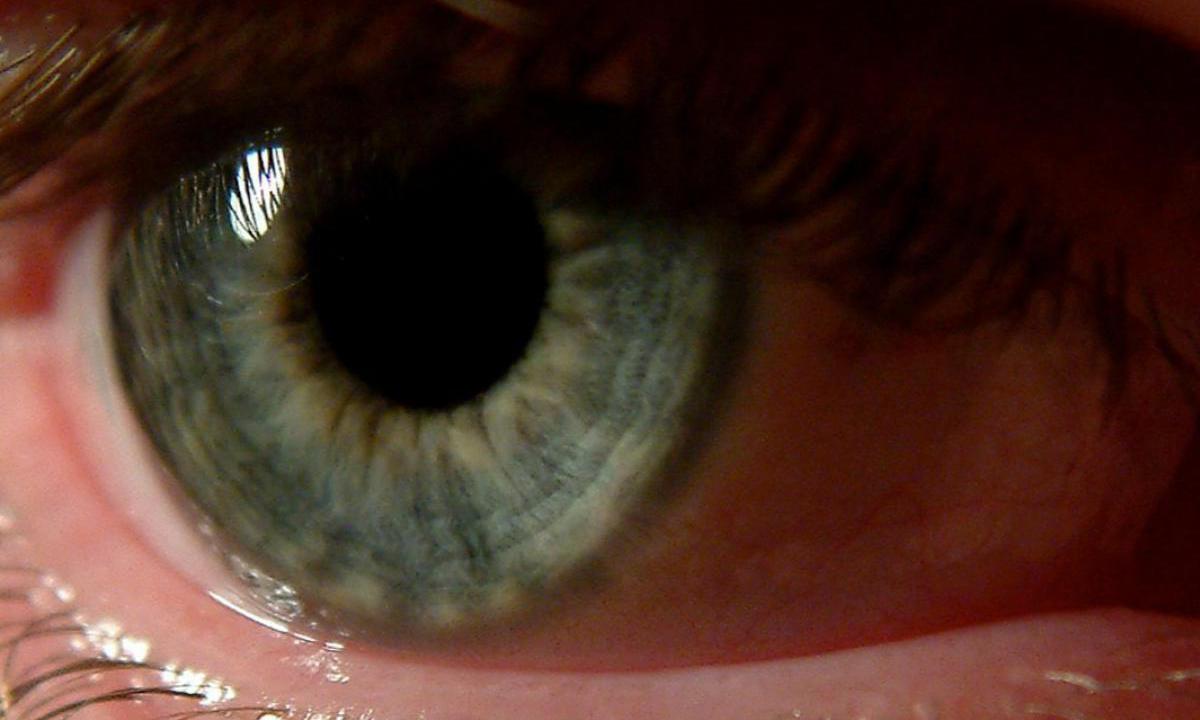 Синдром сухого глаза: причины и профилактика