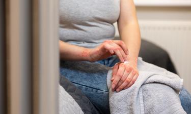 Псориаз нельзя вылечить, но можно контролировать — дерматолог Сафонова