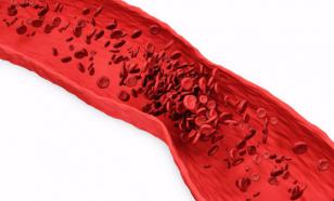 Кардиолог Кореневич рассказала, что человек чувствует при отрыве тромба