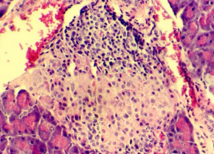 Имплантация клеток: революционный шаг в лечении сахарного диабета 1 типа