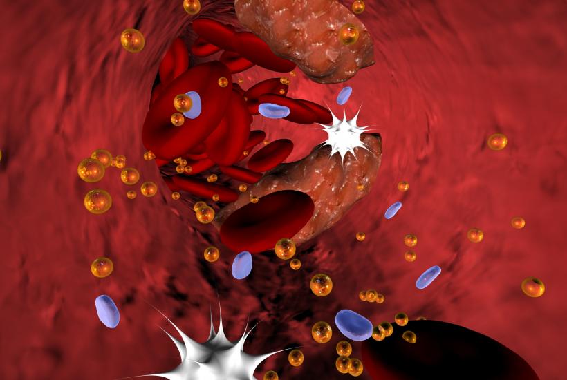 атеросклероз