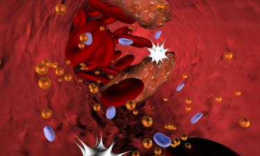 Признаки атеросклероза по давлению выделили кардиологи