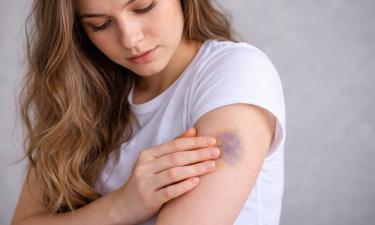 Синяки появляются сами собой: какие заболевания маскируются под безобидные кровоподтеки