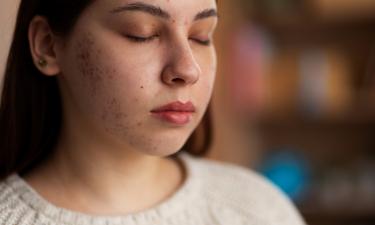 Лицо как после шторма: как вернуть гладкость коже, если постакне не хочет уходить