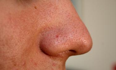 Вы тратите деньги на средства от чёрных точек — и сами того не замечая, вредите коже