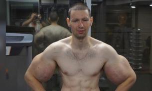 Кирилл Терешин показал "руки-базуки" после операции