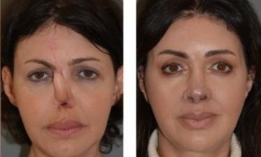 Страшные фото до: удивительное преображение Алисы Аршавиной стало сенсацией