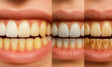 Белизна зубов уходит несмотря на уход — виноваты привычки, которые кажутся безобидными