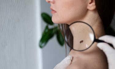 Выглядит безобидно, действует агрессивно: чем опасна меланома кожи