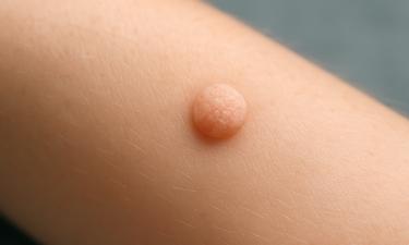 Дерматологи: бородавки передаются через прямой контакт и общие предметы