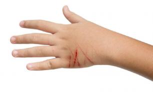 Лимфоретикулёз доброкачественный: что за болезнь и как лечить