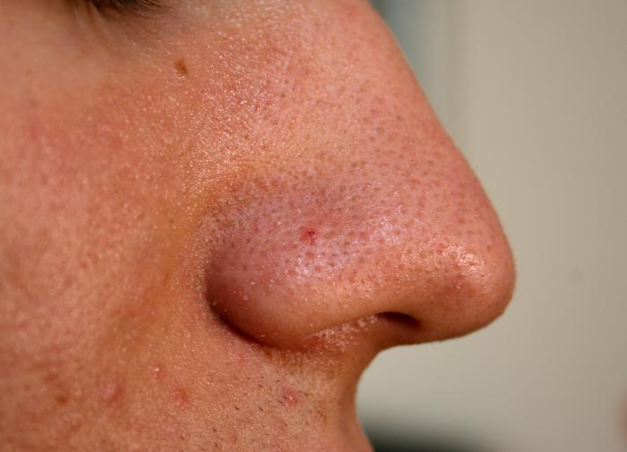 Американские ученые обнаружили, что акне защищают кожу от вредных бактерий