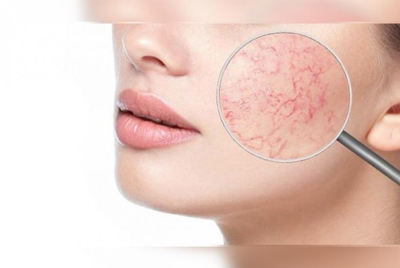 Горячая еда и алкоголь усиливают сосудистую сетку на лице — дерматолог Сафонова