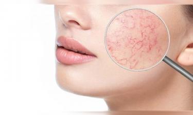 Горячая еда и алкоголь усиливают сосудистую сетку на лице — дерматолог Сафонова