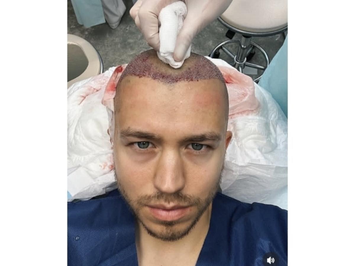 Прощай, лысина: Сергей Романович сделал операцию по пересадке волос