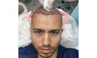 Прощай, лысина: Сергей Романович сделал операцию по пересадке волос