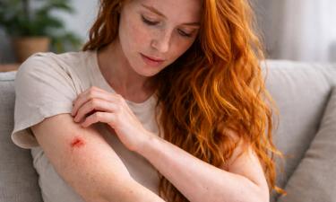 Ген MC1R оказался нарушен при хронических ранах кожи