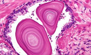 Онколог Карпин заявил, что обнаружен опасный индикатор рака простаты