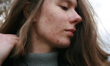 Акне не заразно и связано с внутренними нарушениями организма — дерматолог Вишня