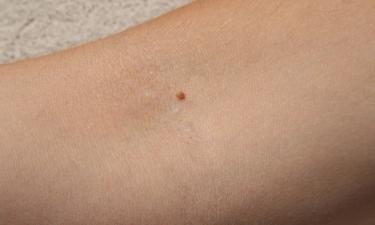 Дерматологи относят изменяющиеся родинки к признакам меланомы