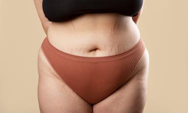 Секрет гладкой кожи: кремы, которые работают, даже если растяжки старые