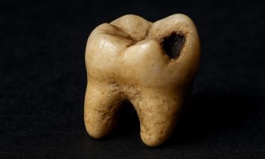 Инфекция под маской улыбки: почему кариес превращается в источник хронических болезней