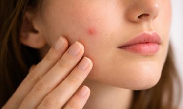 Лицо подвело в последний момент? Быстрые приёмы, которые спасают от прыща за часы