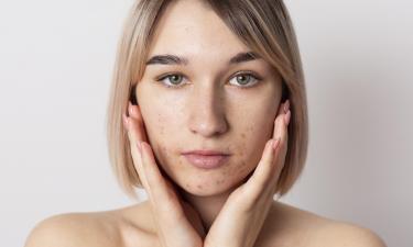 Прыщи не уходят после 30: почему каждая пятая женщина остаётся пленницей акне всю жизнь