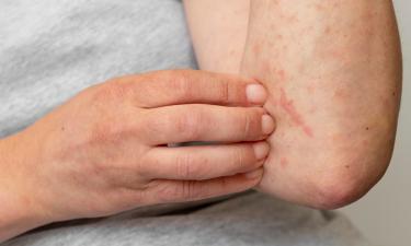 Не просто записи: дневник помогает понять причины обострений дерматита и держать кожу в ремиссии