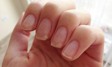 Желтизна ногтей может рассказать о болезни: как отличить следы лака от проблем с печенью
